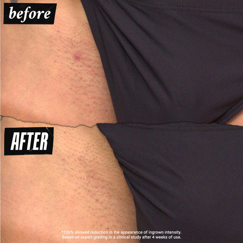 Ingrown Hair and Tone-Correcting Intimate Drops 3