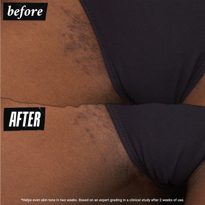 Ingrown Hair and Tone-Correcting Intimate Drops 4