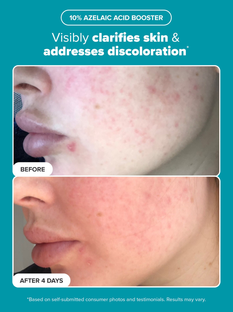 Clarify, Even & Brighten Kit 4